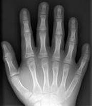 Quince integrantes de una familia cubana tienen seis dedos en extremidades